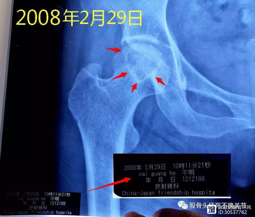 常州人工骨头医保报销多少(人工骨头医保报销多少比例)